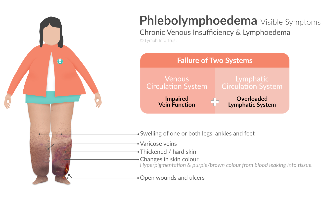 Phlebolymphoedema Visible Symptoms - Chronic Venous Insufficiency and Lymphoedema