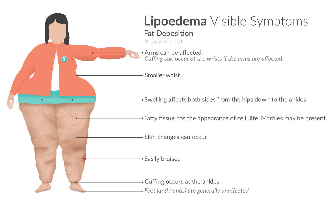 Lipoedema Visible Symptoms - Fat Deposition