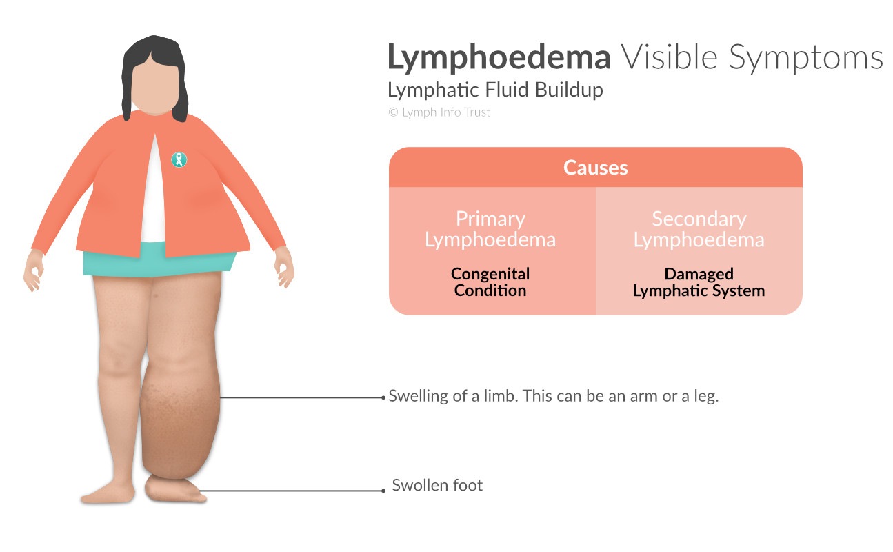 Lymphoedema Visible Symptoms - Lymphatic Fluid Buildup