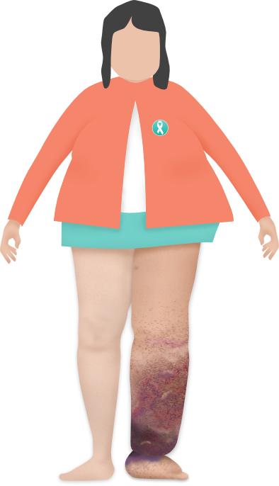 Phlebolymphoedema is a secondary lympoedema