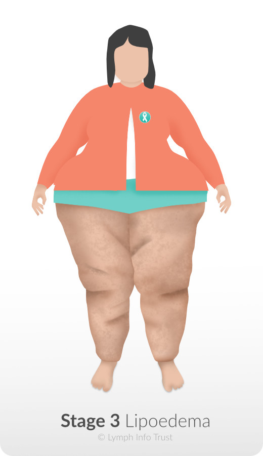 Lipoedema Stage 3: Pronounced Size Difference