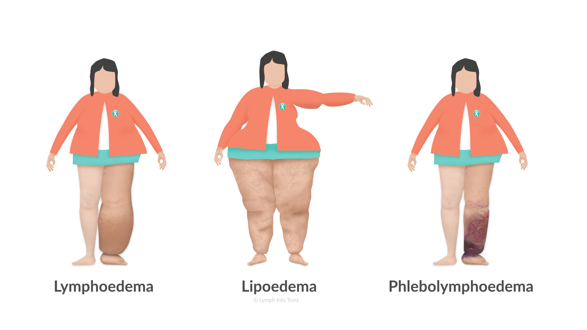 Lympoedema, Lipoedema, and Phlebolymoedema