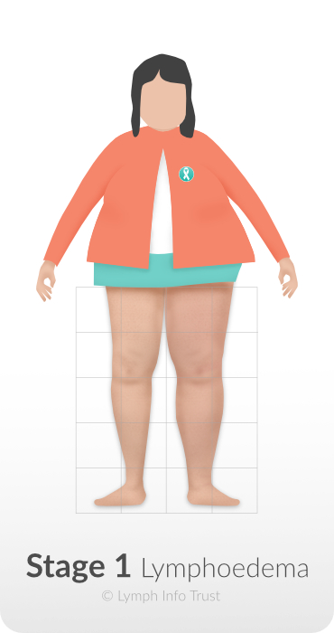 Lymphodema Stage 1 – Reversible Stage